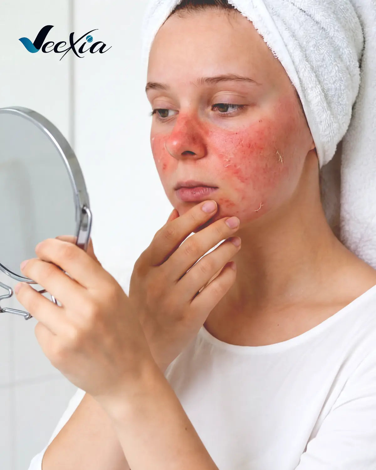 How to Treat Sunburn at Home? Easy Remedies that Work
